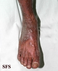pityriasis rubra pilaris