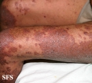 pityriasis rubra pilaris