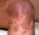 pityriasis rubra pilaris