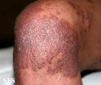 pityriasis rubra pilaris