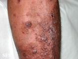 pityriasis rubra pilaris