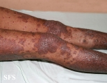 pityriasis rubra pilaris