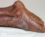 pityriasis rubra pilaris