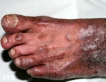 pityriasis rubra pilaris