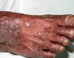 pityriasis rubra pilaris