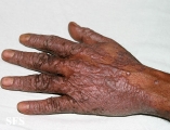 pityriasis rubra pilaris