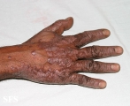 pityriasis rubra pilaris