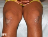 pityriasis rubra pilaris