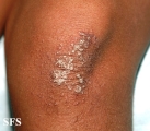 pityriasis rubra pilaris