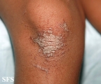 pityriasis rubra pilaris