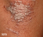 pityriasis rubra pilaris