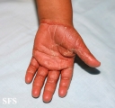 pityriasis rubra pilaris