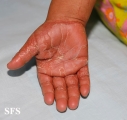 pityriasis rubra pilaris
