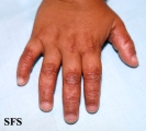 pityriasis rubra pilaris