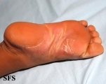 pityriasis rubra pilaris