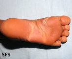 pityriasis rubra pilaris