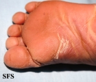 pityriasis rubra pilaris