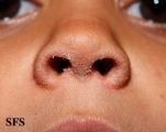 pityriasis rubra pilaris