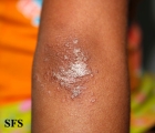 pityriasis rubra pilaris