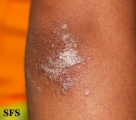 pityriasis rubra pilaris