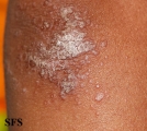 pityriasis rubra pilaris