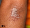 pityriasis rubra pilaris