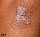 pityriasis rubra pilaris
