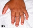 pityriasis rubra pilaris