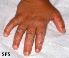 pityriasis rubra pilaris