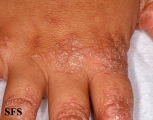 pityriasis rubra pilaris
