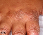 pityriasis rubra pilaris
