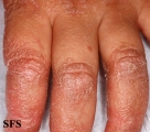 pityriasis rubra pilaris