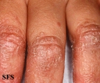 pityriasis rubra pilaris