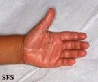 pityriasis rubra pilaris