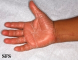 pityriasis rubra pilaris