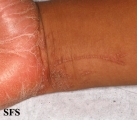 pityriasis rubra pilaris