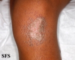 pityriasis rubra pilaris