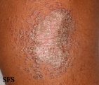 pityriasis rubra pilaris