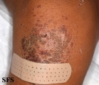 pityriasis rubra pilaris