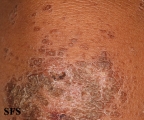 pityriasis rubra pilaris