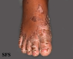 pityriasis rubra pilaris