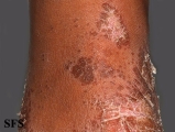 pityriasis rubra pilaris