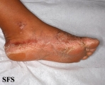 pityriasis rubra pilaris