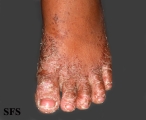 pityriasis rubra pilaris