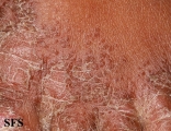 pityriasis rubra pilaris