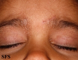 pityriasis rubra pilaris