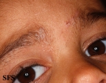 pityriasis rubra pilaris