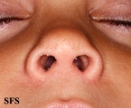 pityriasis rubra pilaris