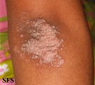 pityriasis rubra pilaris
