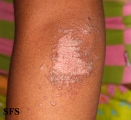 pityriasis rubra pilaris